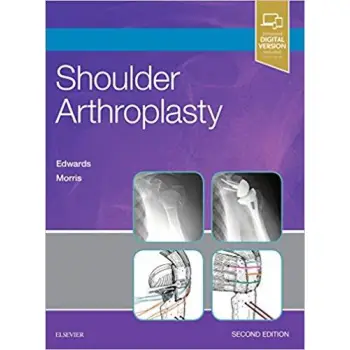 SHOULDER ARTHROPLASTY SHOULDER ARTHROPLASTY